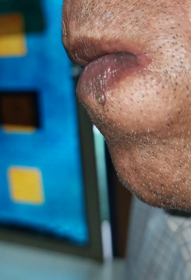 Patients 11 Before